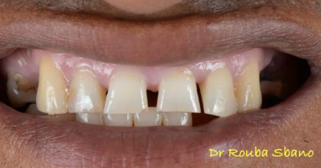 Before Dental Implant