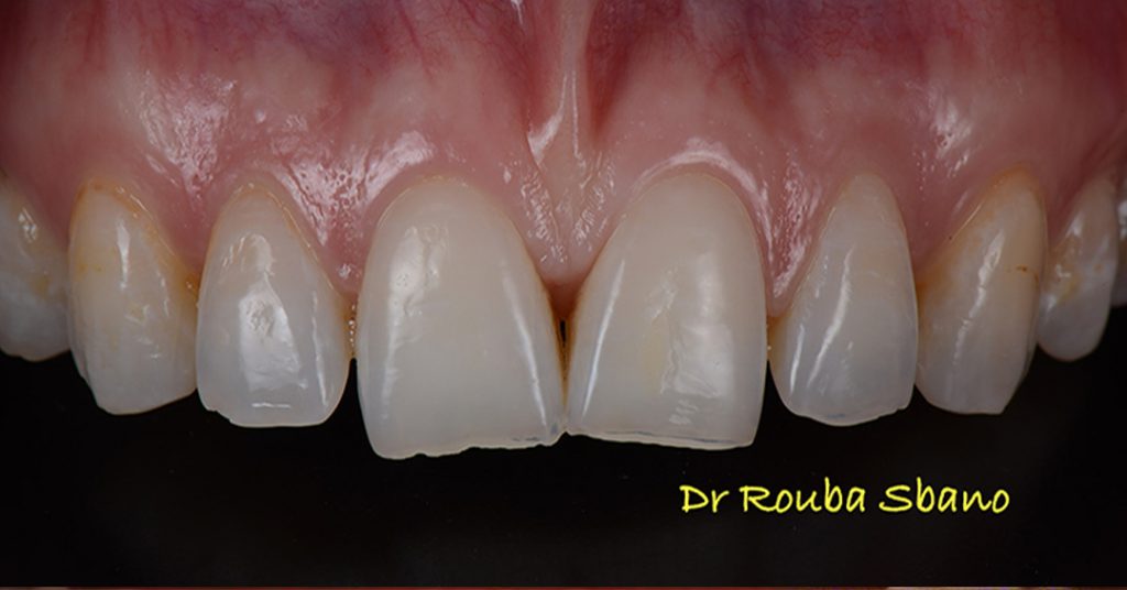 Before Composite Bonding