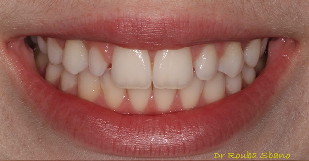 Before Composite Bonding